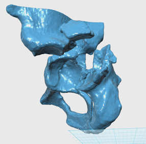 impresion 3d medica tercer paso